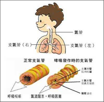 哪里治哮喘(哮喘去哪里治)