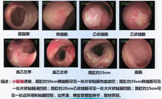 结肠疾病(近年来被列为癌前期病变的结肠疾病)