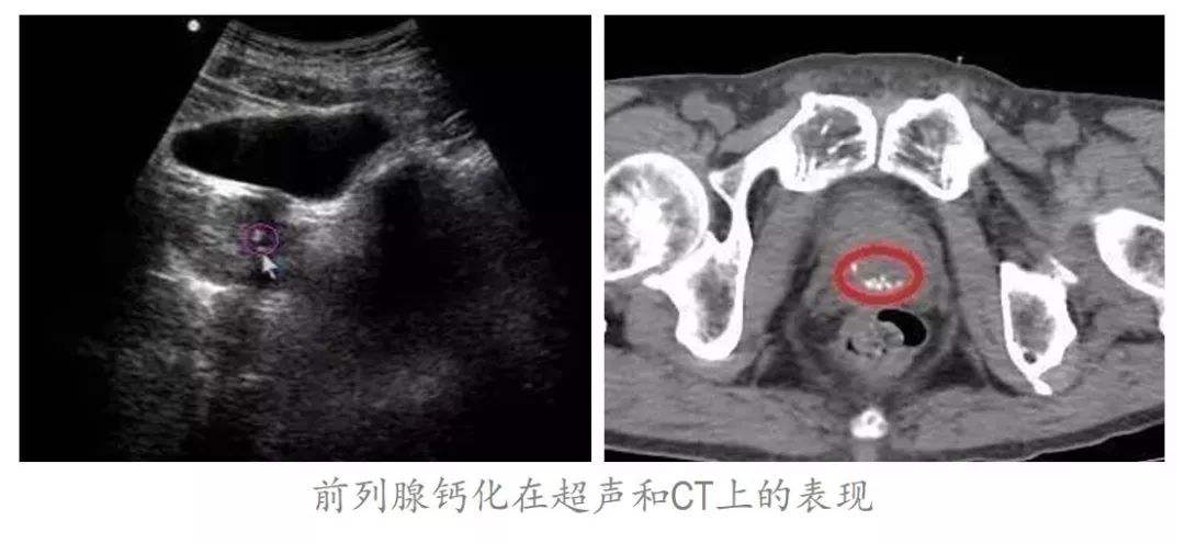 什么是前列腺钙化(什么是前列腺钙化呢?前列腺钙化有什么危害?)